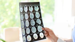 TBI Lawsuits Explained by an Alabama Lawyer