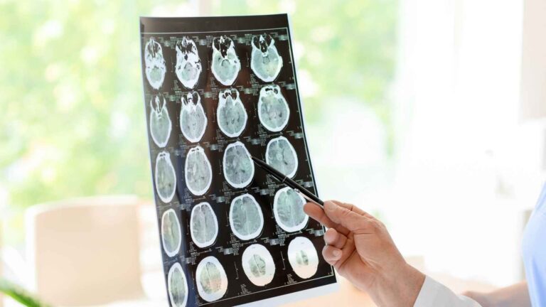 TBI Lawsuits Explained by an Alabama Lawyer